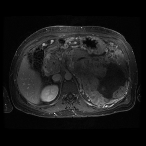 Acinar cell carcinoma of the pancreas (Radiopaedia 75442-86668 Axial T1 C+ fat sat 69).jpg