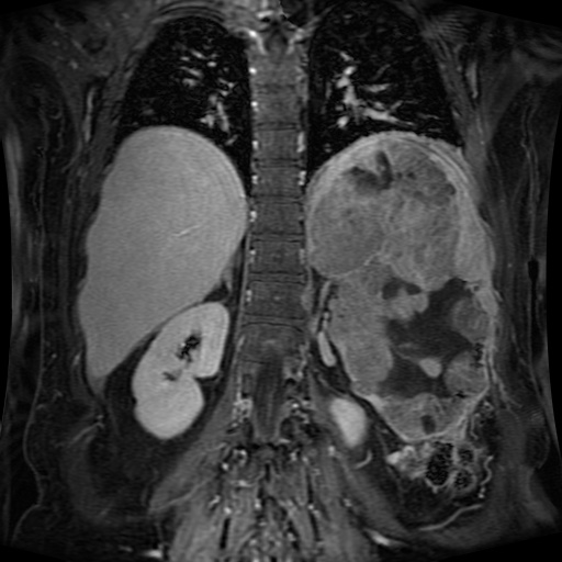 Acinar cell carcinoma of the pancreas (Radiopaedia 75442-86668 Coronal T1 C+ fat sat 61).jpg