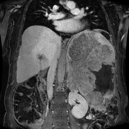 Acinar cell carcinoma of the pancreas (Radiopaedia 75442-86668 Coronal T1 C+ fat sat 90).jpg