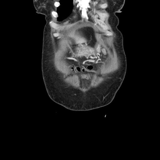 File:Acinar cell carcinoma of the pancreas (Radiopaedia 75442-86669 Coronal C+ portal venous phase 17).jpg