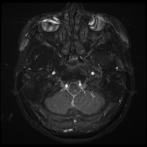 Acoustic neuroma (Radiopaedia 34049-35283 Axial 1).png