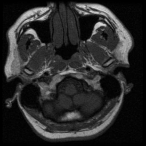 File:Acoustic schwannoma (Radiopaedia 33045-34060 Axial T1 1).png