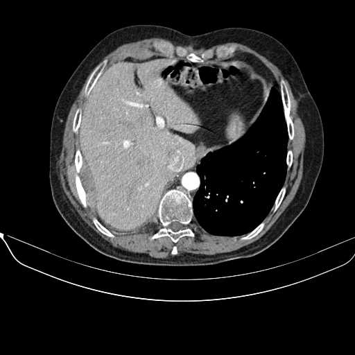 File:Acquired adrenal hyperplasia - due to thymic carcinoid tumor (Radiopaedia 21269-21184 C+ arterial phase 5).jpg
