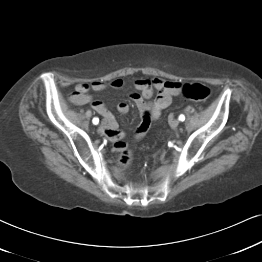 File:Active bleeding from duodenal ulcer with embolization (Radiopaedia 34216-35481 Axial C+ arterial phase 52).png