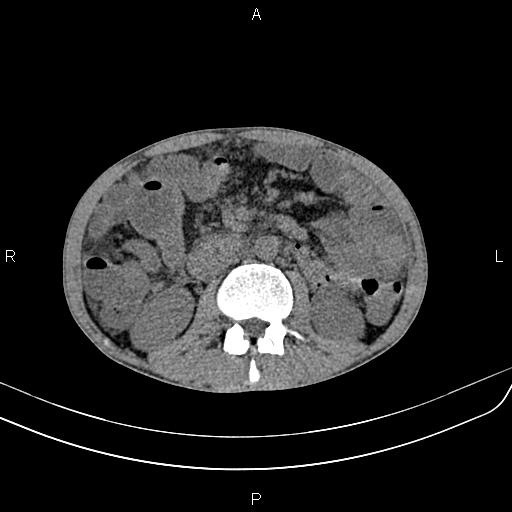 Active crohn disease (Radiopaedia 87133-103397 Axial non-contrast 47).jpg