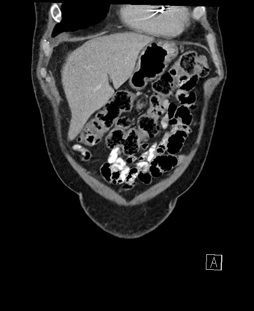 Active lower gastrointestinal bleeding - diverticular (Radiopaedia 61203-69106 Coronal C+ portal venous phase 26).jpg