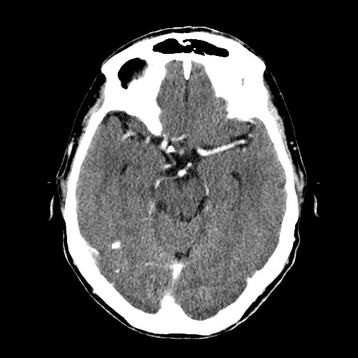 File:Active neurocysticercosis before and after therapy (Radiopaedia 71710-82100 Axial C+ delayed 29).jpg