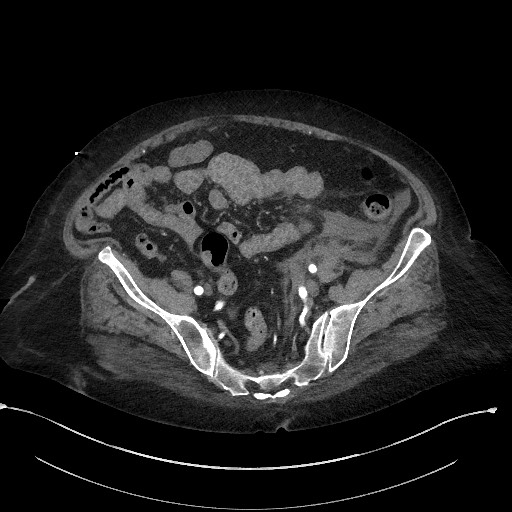 File:Active renal extravasation with large subcapsular and retroperitoneal hemorrhage (Radiopaedia 60975-68796 Axial C+ arterial phase 148).jpg