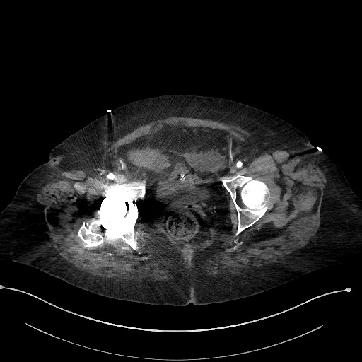 File:Active renal extravasation with large subcapsular and retroperitoneal hemorrhage (Radiopaedia 60975-68796 Axial C+ arterial phase 185).jpg