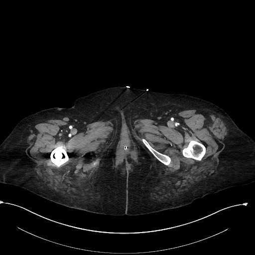 Active renal extravasation with large subcapsular and retroperitoneal hemorrhage (Radiopaedia 60975-68796 Axial C+ arterial phase 216).jpg