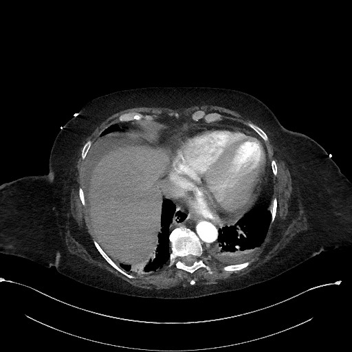 Active renal extravasation with large subcapsular and retroperitoneal hemorrhage (Radiopaedia 60975-68796 Axial C+ arterial phase 24).jpg