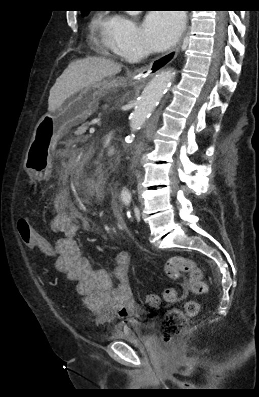 Active renal extravasation with large subcapsular and retroperitoneal hemorrhage (Radiopaedia 60975-68796 Sagittal C+ portal venous phase 117).jpg