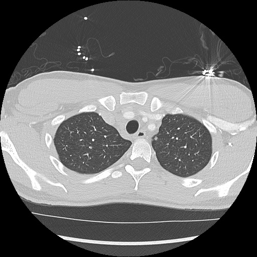 File:Active right ventricular cardiac sarcoidosis (Radiopaedia 55596-62101 Axial lung window 4).jpg