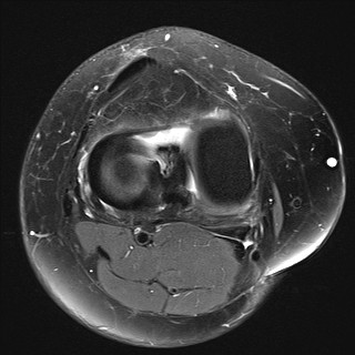 File:Acute-on-chronic transient lateral patellar dislocation with trochlear dysplasia (Radiopaedia 84099-99349 Axial PD fat sat 22).jpg