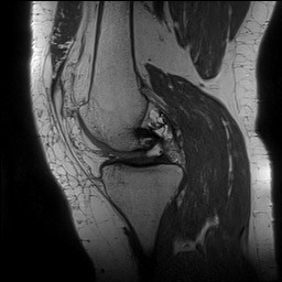 File:Acute-on-chronic transient lateral patellar dislocation with trochlear dysplasia (Radiopaedia 84099-99349 Sagittal PD 68).jpg