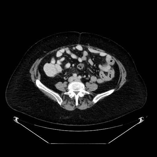 File:Acute appendicitis, heterotaxy syndrome (Radiopaedia 66884-76202 Axial C+ portal venous phase 82).jpg