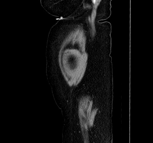 Acute appendicitis, heterotaxy syndrome (Radiopaedia 66884-76202 Sagittal C+ portal venous phase 120).jpg