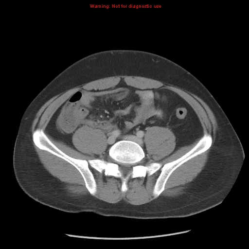 Acute appendicitis (Radiopaedia 10498-10973 Axial C+ portal venous phase 22).jpg