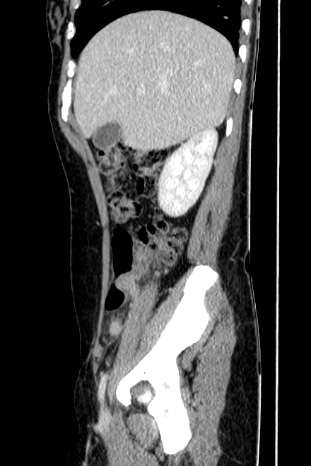 Acute appendicitis (Radiopaedia 22892-22918 Sagittal C+ portal venous phase 23).png