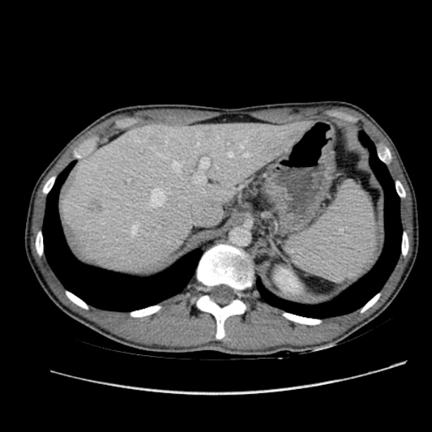 Acute appendicitis (Radiopaedia 27049-27227 Axial C+ portal venous phase 14).jpg