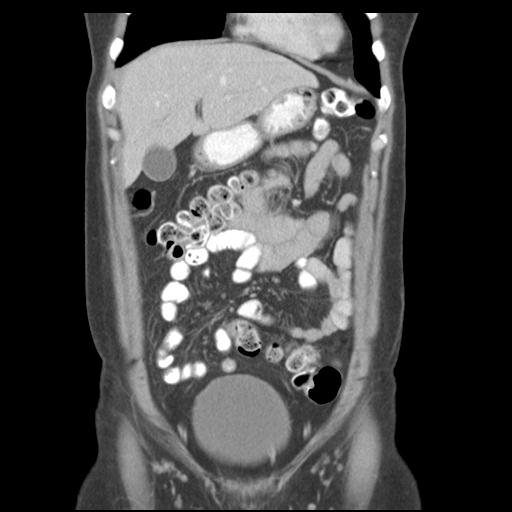 Acute appendicitis (Radiopaedia 30297-30934 Coronal C+ portal venous phase 13).jpg