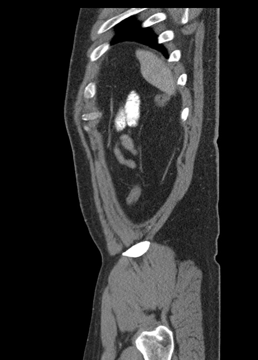 Acute appendicitis (Radiopaedia 48511-53463 Sagittal C+ portal venous phase 115).jpg