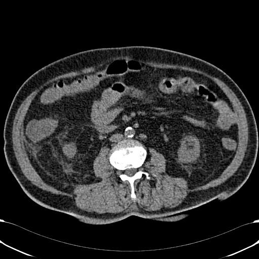 Acute appendicitis (Radiopaedia 58627-65818 Axial non-contrast 46).jpg
