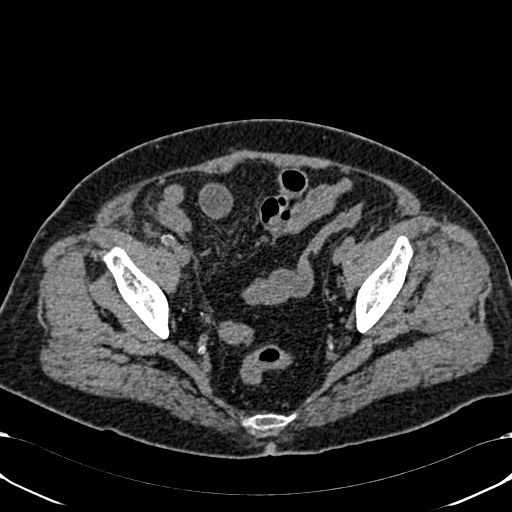Acute appendicitis (Radiopaedia 58627-65818 Axial non-contrast 75).jpg