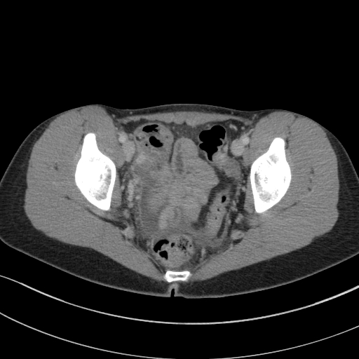 Acute appendicitis (Radiopaedia 62608-70901 Axial C+ portal venous phase 44).jpg