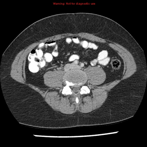 File:Acute appendicitis (Radiopaedia 7966-8812 C+ portal venous phase 31).jpg