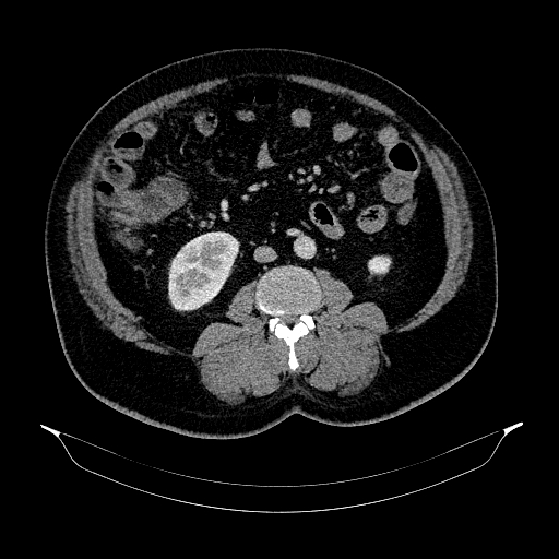 Acute appendicitis (Radiopaedia 79950-93224 Axial C+ portal venous phase 54).jpg