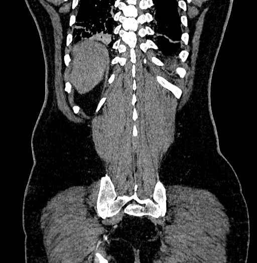 File:Acute appendicitis (Radiopaedia 79950-93224 Coronal C+ portal venous phase 82).jpg