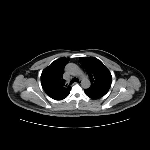 Acute appendicitis and COVID 19 pneumonia (Radiopaedia 76604-88380 Axial non-contrast 19).jpg