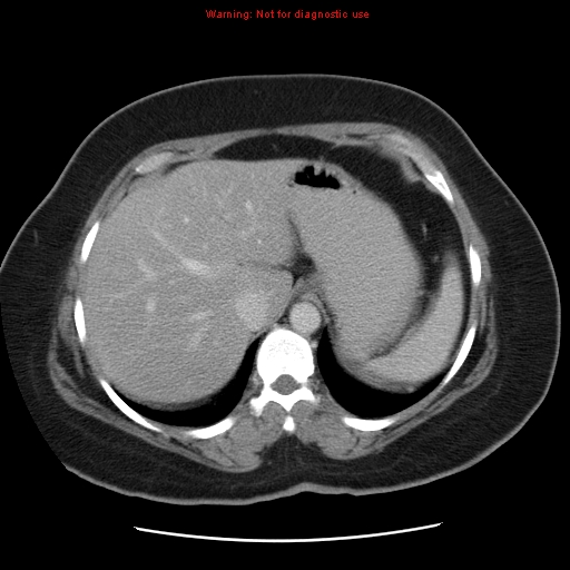 Acute appendicitis complicated by ovarian vein thrombophlebitis (Radiopaedia 16172-15851 Axial C+ portal venous phase 21).jpg