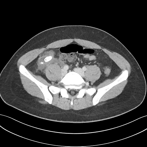 File:Acute appendicitis with appendicoliths (Radiopaedia 50186-55532 Axial C+ portal venous phase 56).png
