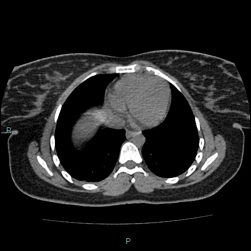 Acute bilateral pyelonephritis (Radiopaedia 37146-38881 Axial non-contrast 2).jpg