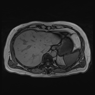 File:Acute cholecystitis (Radiopaedia 72392-82923 Axial T1 out-of-phase 32).jpg