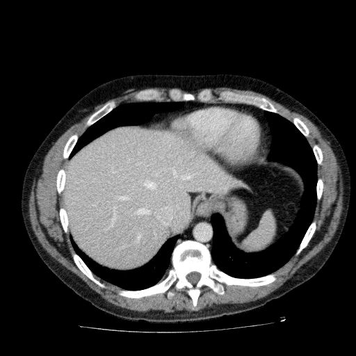File:Acute cholecystitis and incidental left sided IVC (Radiopaedia 49352-54459 Axial C+ portal venous phase 29).jpg