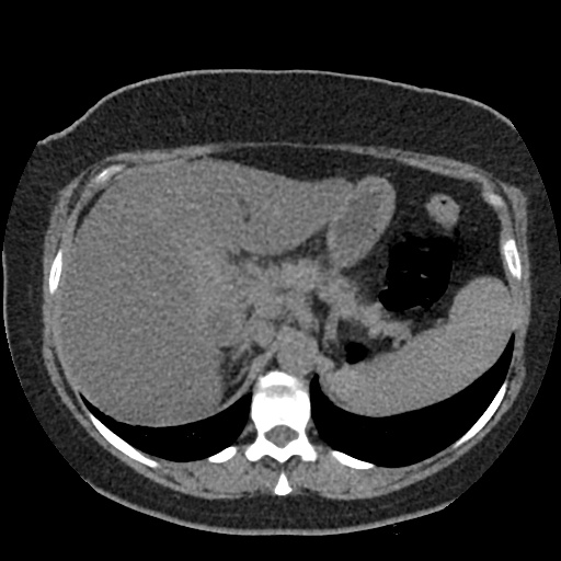 File:Acute cholecystitis and ureteric colic (Radiopaedia 42330-45444 Axial prone 16).jpg