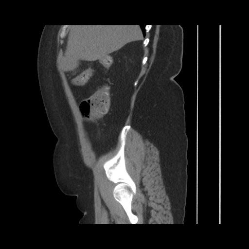 File:Acute cholecystitis with tensile fundus sign (Radiopaedia 71394-81723 Sagittal non-contrast 51).jpg