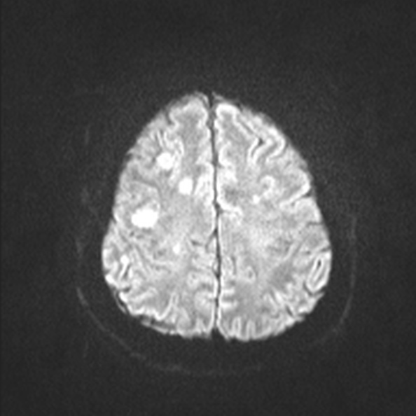 Acute disseminated encephalomyelitis (Radiopaedia 37253-39033 Axial DWI 48).jpg