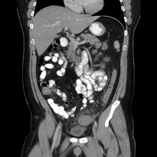Acute diverticulitis with localized perforation (Radiopaedia 41296-44113 Coronal C+ portal venous phase 29).jpg