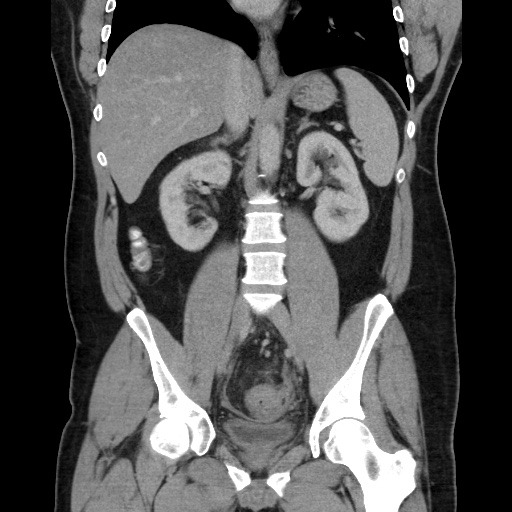 File:Acute diverticulitis with localized perforation (Radiopaedia 41296-44113 Coronal C+ portal venous phase 37).jpg
