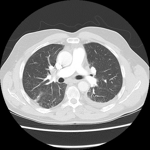 Acute epicardial fat necrosis (Radiopaedia 42327-45440 Axial lung window 28).jpg