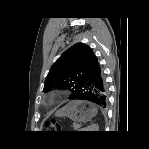 Acute epicardial fat necrosis (Radiopaedia 42327-45440 Sagittal C+ CTPA 56).jpg