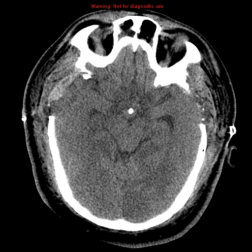 File:Acute hemorrhagic leukoencephalitis (Radiopaedia 14076-43697 Axial non-contrast 19).jpg