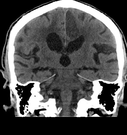 Acute left anterior cerebral artery territory infarction (Radiopaedia 51785-57578 Coronal non-contrast 35).jpg