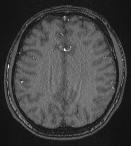Acute left middle cerebral artery territory infarct with clot retrieval (Radiopaedia 47732-52433 Axial MRA 45).png