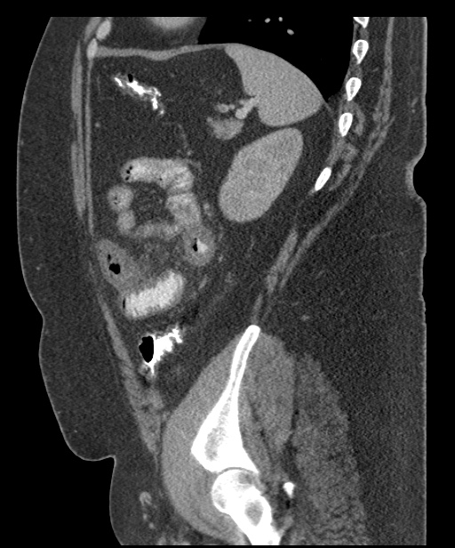 Acute mesenteric venous ischemia (Radiopaedia 46041-50383 Sagittal C+ portal venous phase 90).jpg