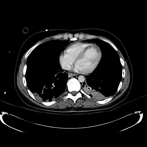 Acute myocardial infarction in CT (Radiopaedia 39947-42415 Axial C+ portal venous phase 4).jpg